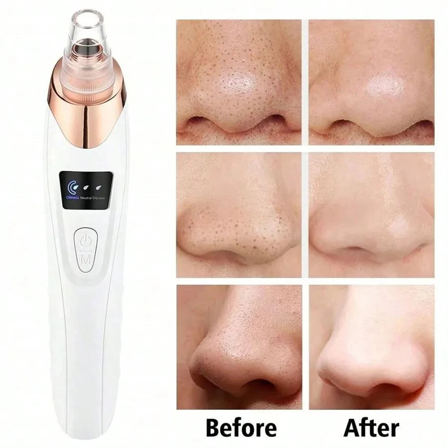 DIVERSE DEPOT™ - Deep Pore Blackhead & Whitehead Remover | Imported Quality