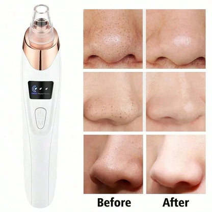 DIVERSE DEPOT™ - Deep Pore Blackhead & Whitehead Remover | Imported Quality