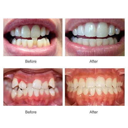 DIVERSE DEPOT™ - Jawline & Teeth Alignment Mouth Retainer