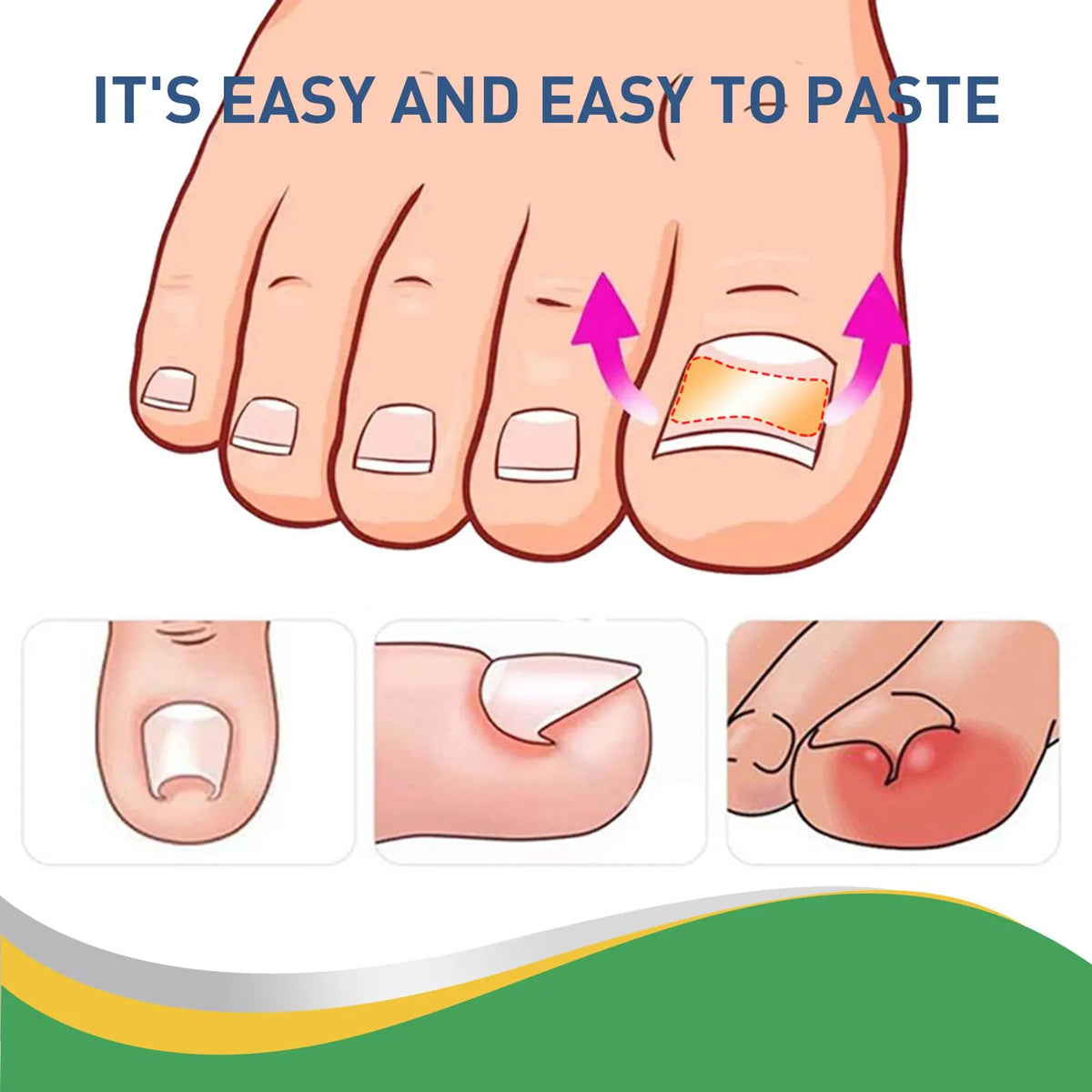 Quick Toe Nail Correction Patches | DIVERSE DEPOT®