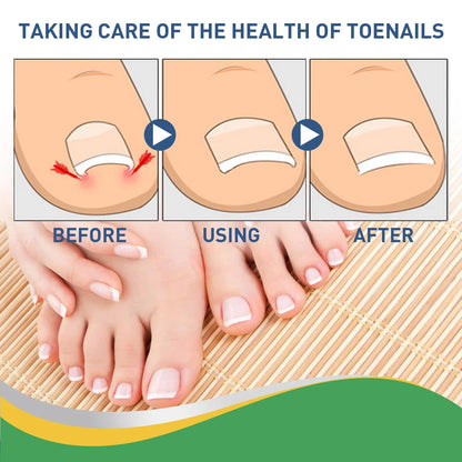 Quick Toe Nail Correction Patches | DIVERSE DEPOT®