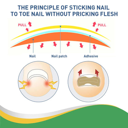 Quick Toe Nail Correction Patches | DIVERSE DEPOT®