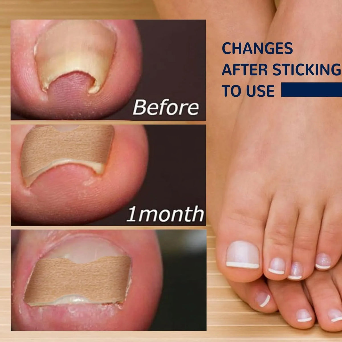 Quick Toe Nail Correction Patches | DIVERSE DEPOT®