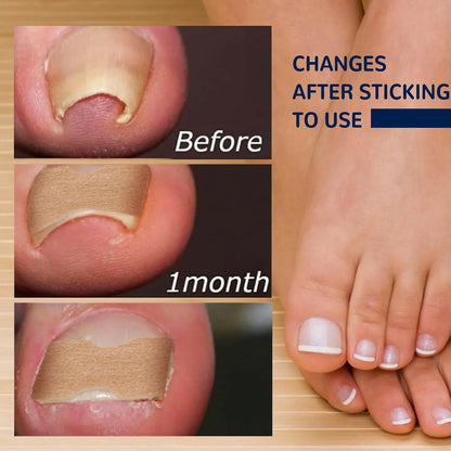 Quick Toe Nail Correction Patches | DIVERSE DEPOT®